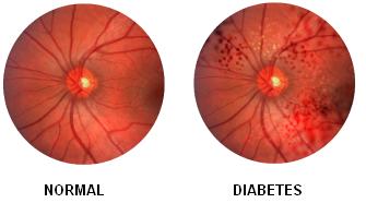 retinopatia diabetes