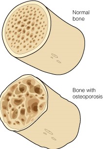 deficiencia vitamina D osteoporose
